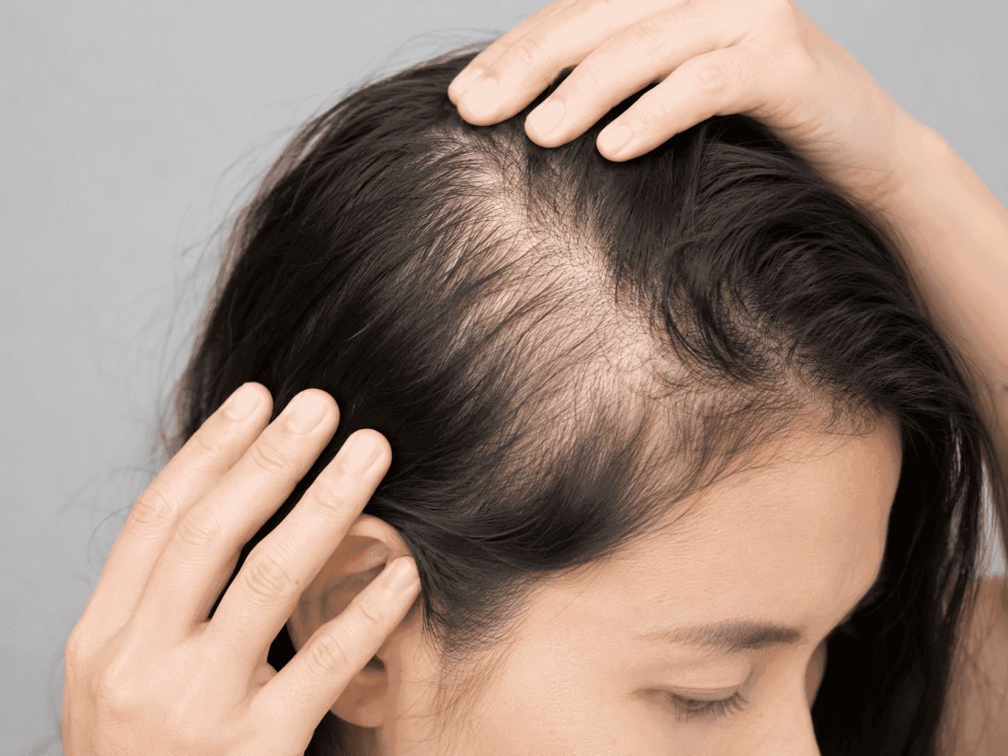 Female pattern alopecia showing scalp visibility